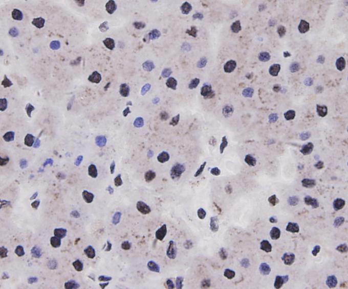 Fig3: Immunohistochemical analysis of paraffin-embedded human liver carcinoma tissue using anti-Cyclin D1 antibody. Counter stained with hematoxylin.
