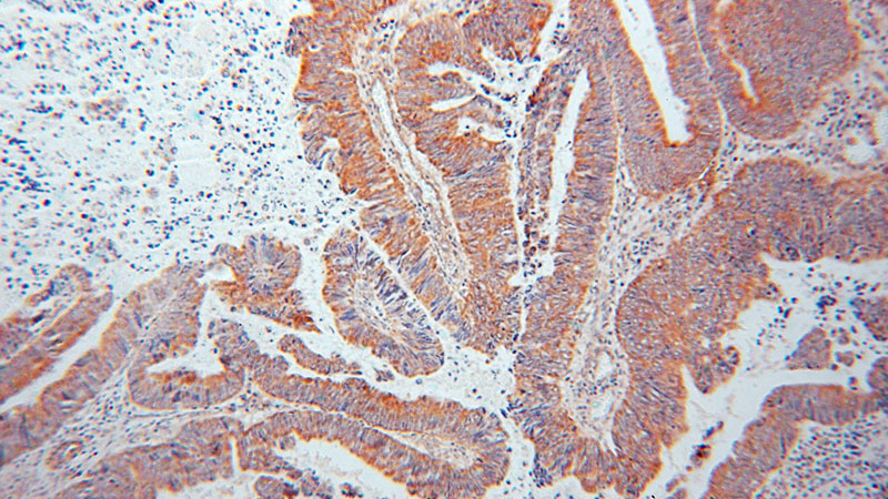Immunohistochemical of paraffin-embedded human colon cancer using Catalog No:109570(DPYSL2 antibody) at dilution of 1:50 (under 10x lens)