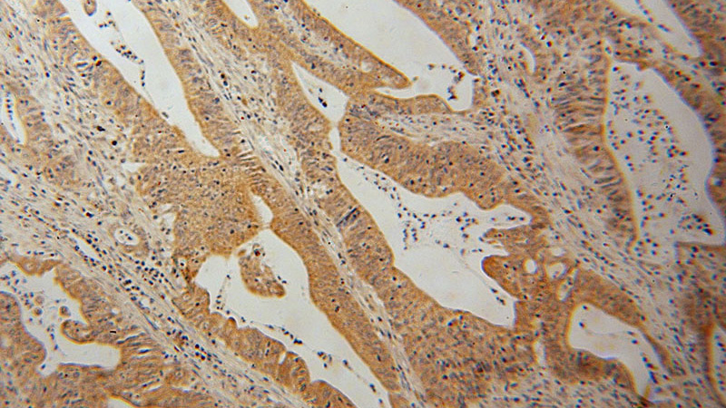 Immunohistochemical of paraffin-embedded human colon cancer using Catalog No:112409(LYPLA1 antibody) at dilution of 1:100 (under 10x lens)