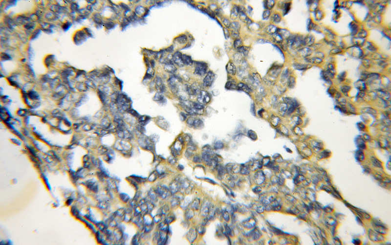Immunohistochemical of paraffin-embedded human ovary tumor using Catalog No:116758(NAMPT antibody) at dilution of 1:50 (under 10x lens)