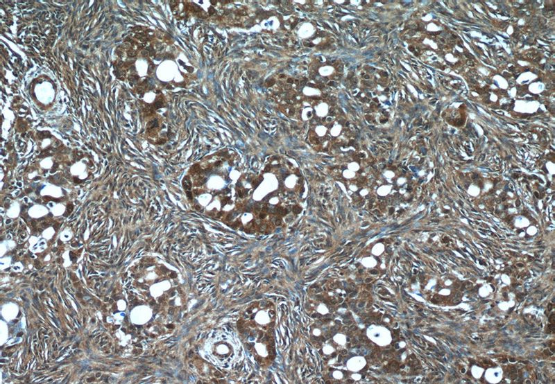 Immunohistochemistry of paraffin-embedded human ovary tumor tissue slide using Catalog No:114390(PSMC3 Antibody) at dilution of 1:50 (under 10x lens)