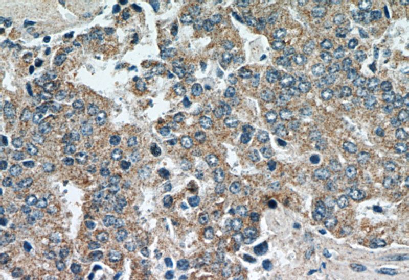 Immunohistochemical of paraffin-embedded human prostate cancer using Catalog No:111168(GSK3A antibody) at dilution of 1:50 (under 40x lens)