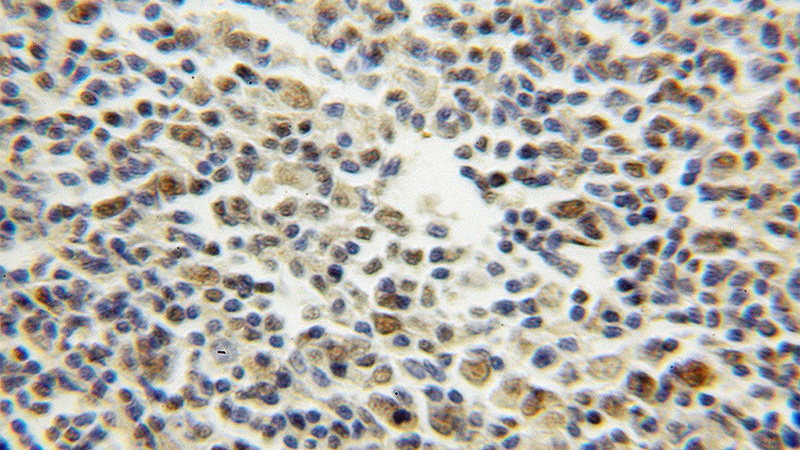 Immunohistochemical of paraffin-embedded human lymphoma using Catalog No:115914(TCOF1 antibody) at dilution of 1:50 (under 10x lens)