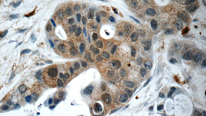 Immunohistochemistry of paraffin-embedded human liver cancer slide using Catalog No:111058(GPATCH4 Antibody) at dilution of 1:50