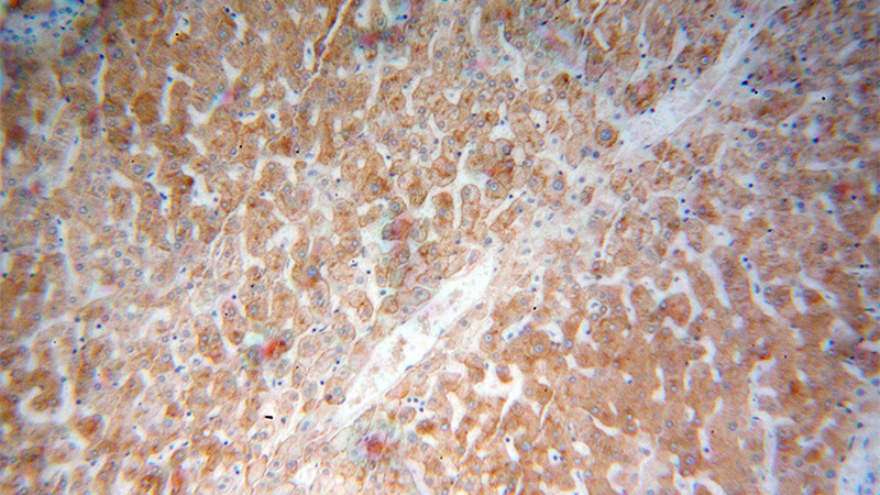 Immunohistochemical of paraffin-embedded human liver cancer using Catalog No:108226(ASGR1 antibody) at dilution of 1:100 (under 10x lens)