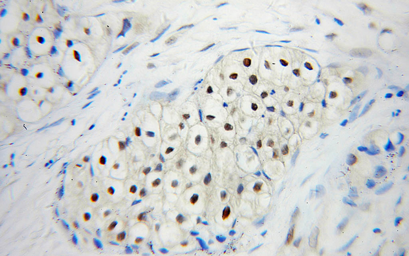 Immunohistochemical of paraffin-embedded human lung cancer using Catalog No:116509(UBC9 antibody) at dilution of 1:50 (under 40x lens)
