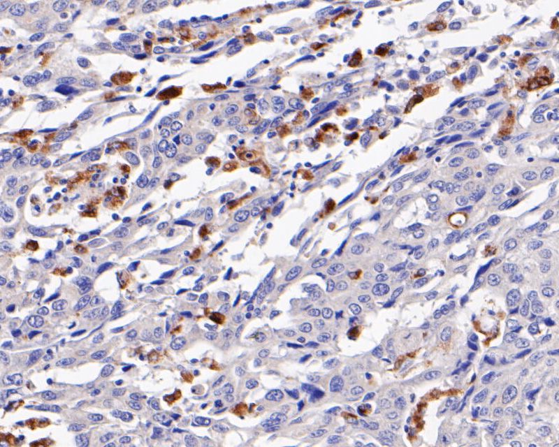 Fig4:; Immunohistochemical analysis of paraffin-embedded human lung cancer tissue using anti-CD68 antibody. The section was pre-treated using heat mediated antigen retrieval with Tris-EDTA buffer (pH 8.0-8.4) for 20 minutes.The tissues were blocked in 5% BSA for 30 minutes at room temperature, washed with ddH; 2; O and PBS, and then probed with the primary antibody ( 1/200) for 30 minutes at room temperature. The detection was performed using an HRP conjugated compact polymer system. DAB was used as the chromogen. Tissues were counterstained with hematoxylin and mounted with DPX.