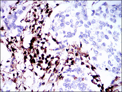 Immunohistochemical analysis of paraffin-embedded breast cancer tissues using PTPRC mouse mAb with DAB staining.