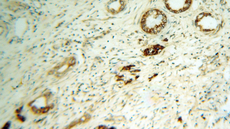 Immunohistochemical of paraffin-embedded human pancreas cancer using Catalog No:115127(ATP2A3 antibody) at dilution of 1:100 (under 10x lens)