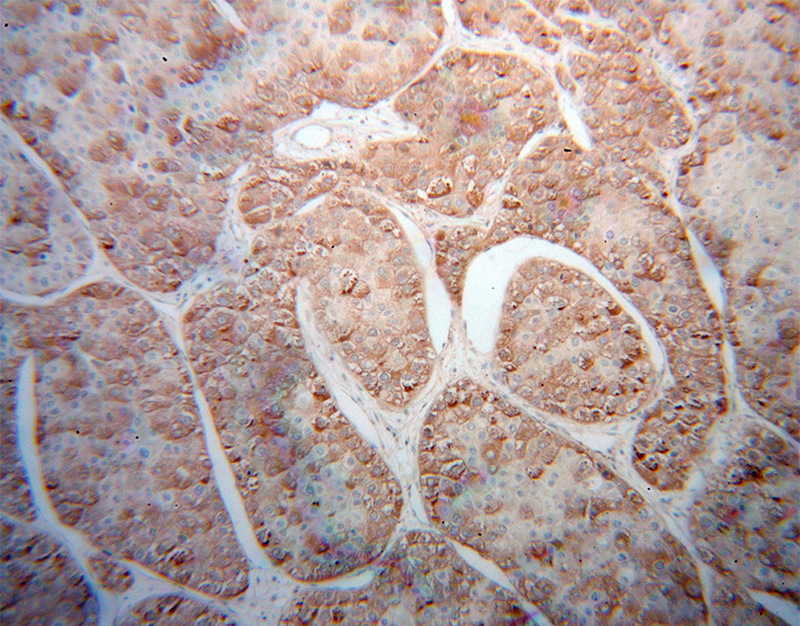 Immunohistochemical of paraffin-embedded human liver cancer using Catalog No:109701(CYP3A5 antibody) at dilution of 1:100 (under 10x lens)