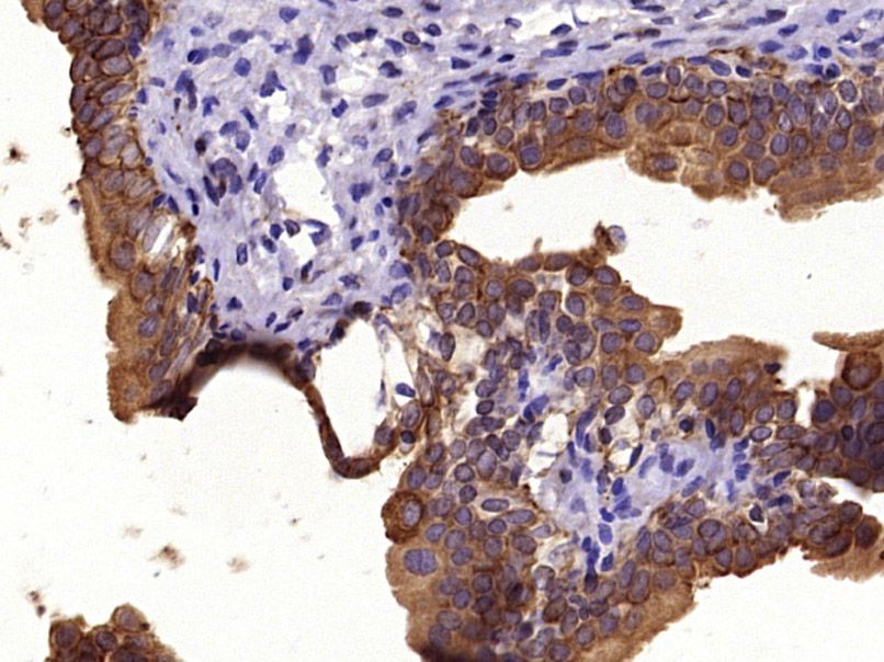 Fig1: Paraformaldehyde-fixed, paraffin embedded (Rat bladder); Antigen retrieval by boiling in sodium citrate buffer (pH6.0) for 15min; Block endogenous peroxidase by 3% hydrogen peroxide for 20 minutes; Blocking buffer (normal goat serum) at 37℃ for 30min; Antibody incubation with (Pan Cytokeratin) Polyclonal Antibody, Unconjugated at 1:400 overnight at 4℃, followed by operating according to SP Kit(Rabbit) (sp-0023) instructionsand DAB staining.