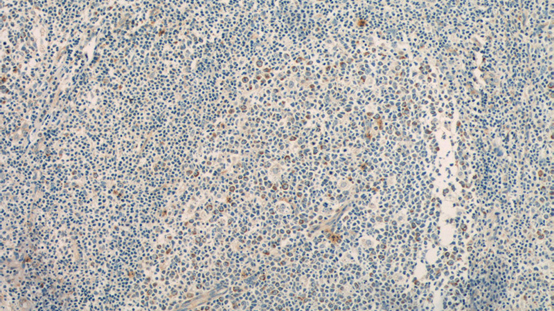 Immunohistochemistry of paraffin-embedded human tonsillitis tissue slide using Catalog No:109149(KLRD1 Antibody) at dilution of 1:50 (under 10x lens)