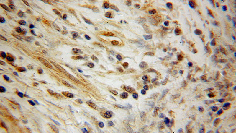 Immunohistochemical of paraffin-embedded human cervical cancer using Catalog No:109608(CSRP1 antibody) at dilution of 1:100 (under 40x lens)