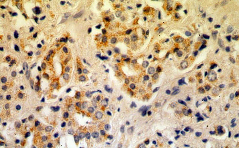 Immunohistochemical of paraffin-embedded human prostate cancer using Catalog No:112109(KLK3,PSA antibody) at dilution of 1:50 (under 40x lens)