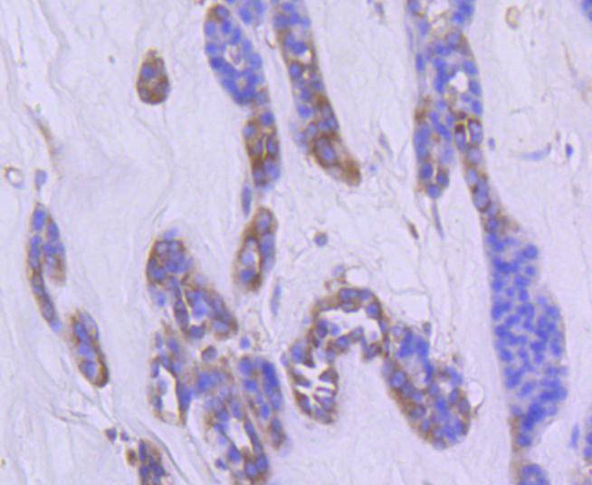 Fig4:; Immunohistochemical analysis of paraffin-embedded human liver carcinoma tissue using anti-Phospho-PAK1(S144)+PAK2(S141)+PAK3(S139) antibody. The section was pre-treated using heat mediated antigen retrieval with Tris-EDTA buffer (pH 8.0-8.4) for 20 minutes.The tissues were blocked in 5% BSA for 30 minutes at room temperature, washed with ddH; 2; O and PBS, and then probed with the primary antibody ( 1/50) for 30 minutes at room temperature. The detection was performed using an HRP conjugated compact polymer system. DAB was used as the chromogen. Tissues were counterstained with hematoxylin and mounted with DPX.
