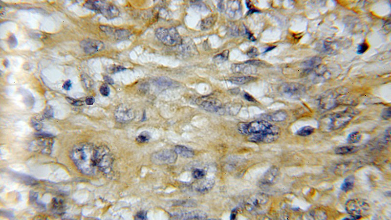Immunohistochemical of paraffin-embedded human gliomas using Catalog No:113006(MZB1 antibody) at dilution of 1:50 (under 40x lens)
