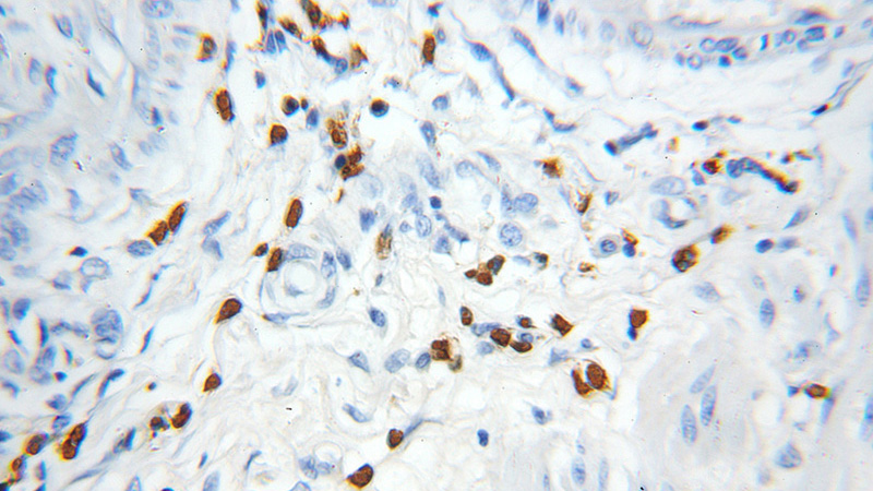 Immunohistochemical of paraffin-embedded human colon cancer using Catalog No:114201(PRKD2 antibody) at dilution of 1:100 (under 10x lens)