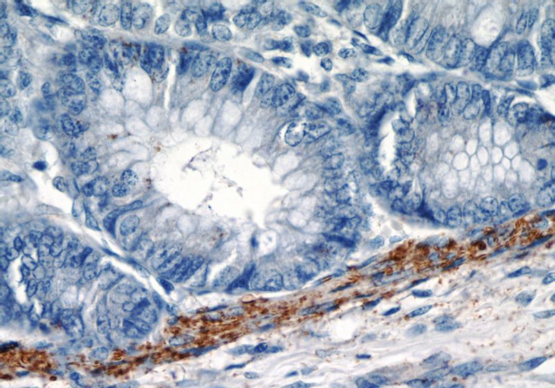 Immunohistochemistry of paraffin-embedded human colon tissue slide using Catalog No:116810(VWA2 Antibody) at dilution of 1:50