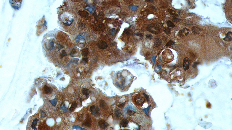 Immunohistochemistry of paraffin-embedded human breast cancer tissue slide using Catalog No:116507(UBE2N Antibody) at dilution of 1:200 (under 40x lens)