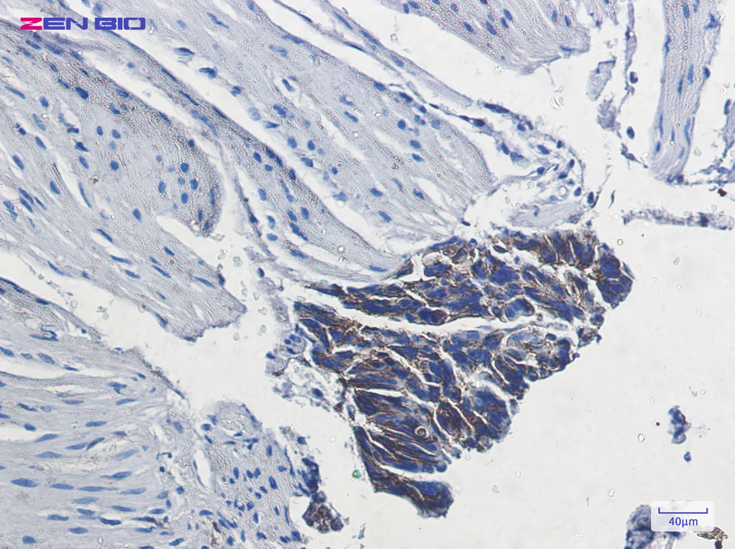 Immunohistochemistry of ATP1B1 in paraffin-embedded Human colon cancer tissue using ATP1B1 Rabbit pAb at dilution 1/20