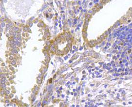 Fig4: Immunohistochemical analysis of paraffin- embedded human lung cancer tissue using anti-FPR2 rabbit polyclonal antibody.