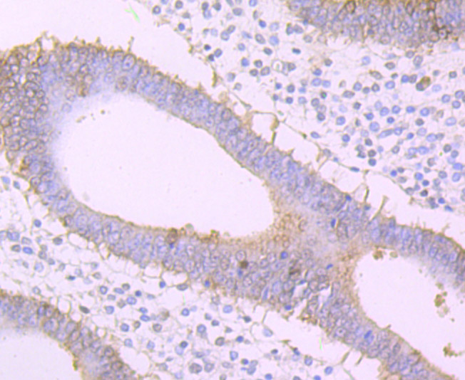 Fig2:; Immunohistochemical analysis of paraffin-embedded human uterus tissue using anti-Frizzled 8 antibody. The section was pre-treated using heat mediated antigen retrieval with Tris-EDTA buffer (pH 8.0-8.4) for 20 minutes.The tissues were blocked in 5% BSA for 30 minutes at room temperature, washed with ddH; 2; O and PBS, and then probed with the primary antibody ( 1/50) for 30 minutes at room temperature. The detection was performed using an HRP conjugated compact polymer system. DAB was used as the chromogen. Tissues were counterstained with hematoxylin and mounted with DPX.