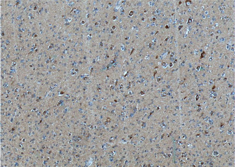 Immunohistochemistry of paraffin-embedded human gliomas tissue slide using Catalog No:107584(APP Antibody) at dilution of 1:200 (under 10x lens). heat mediated antigen retrieved with Tris-EDTA buffer(pH9).