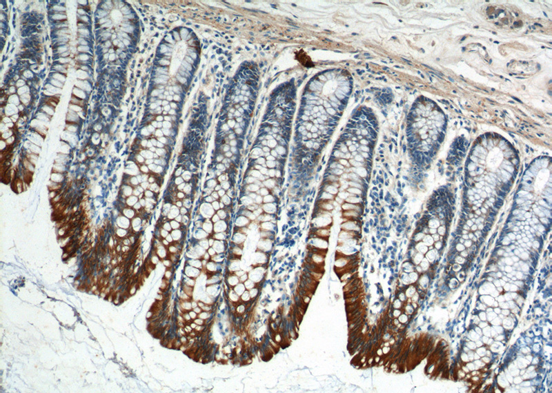 Immunohistochemistry of paraffin-embedded human colon tissue slide using Catalog No:109813(KRT8 Antibody) at dilution of 1:200 (under 10x lens).