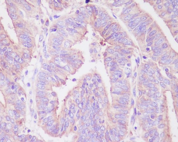 Immunohistochemical analysis of paraffin-embedded human uterus cancer, using Phospho-FoxO3a (S253) Antibody.