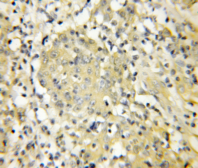 Immunohistochemical of paraffin-embedded human colon cancer using Catalog No:116517(UBE2C antibody) at dilution of 1:50 (under 10x lens)