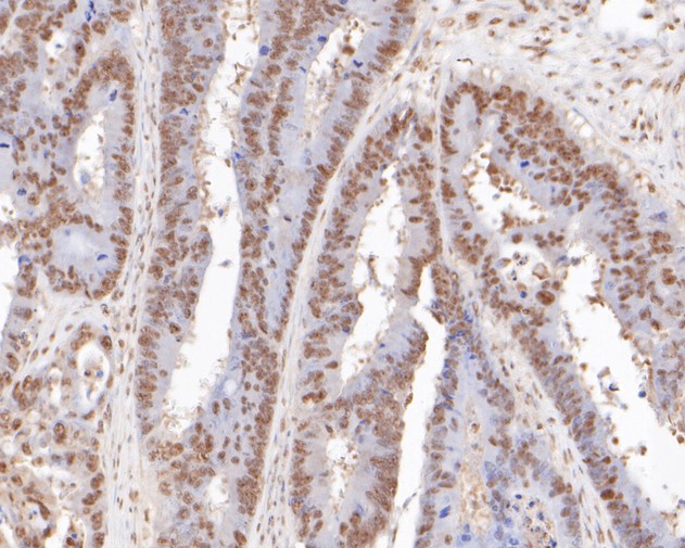 Fig2:; Immunohistochemical analysis of paraffin-embedded human colon carcinoma tissue using anti-OC-3 antibody. The section was pre-treated using heat mediated antigen retrieval with sodium citrate buffer (pH 6.0) for 20 minutes. The tissues were blocked in 5% BSA for 30 minutes at room temperature, washed with ddH; 2; O and PBS, and then probed with the primary antibody ( 1/400) for 30 minutes at room temperature. The detection was performed using an HRP conjugated compact polymer system. DAB was used as the chromogen. Tissues were counterstained with hematoxylin and mounted with DPX.