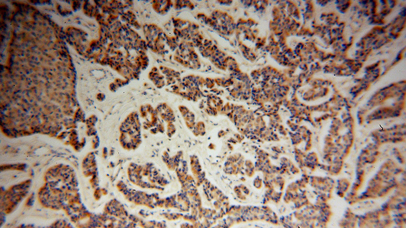 Immunohistochemical of paraffin-embedded human breast cancer using Catalog No:112261(KMO antibody) at dilution of 1:100 (under 10x lens)