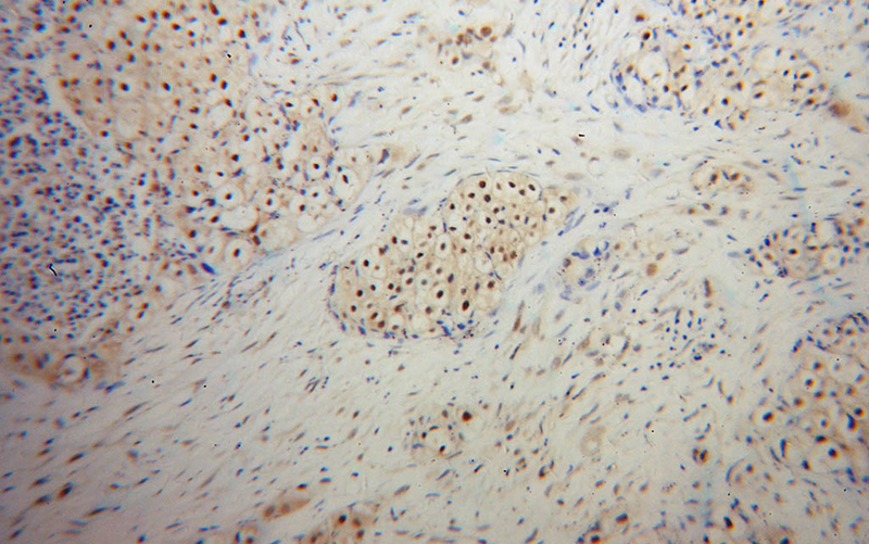 Immunohistochemical of paraffin-embedded human lung cancer using Catalog No:116509(UBC9 antibody) at dilution of 1:50 (under 10x lens)