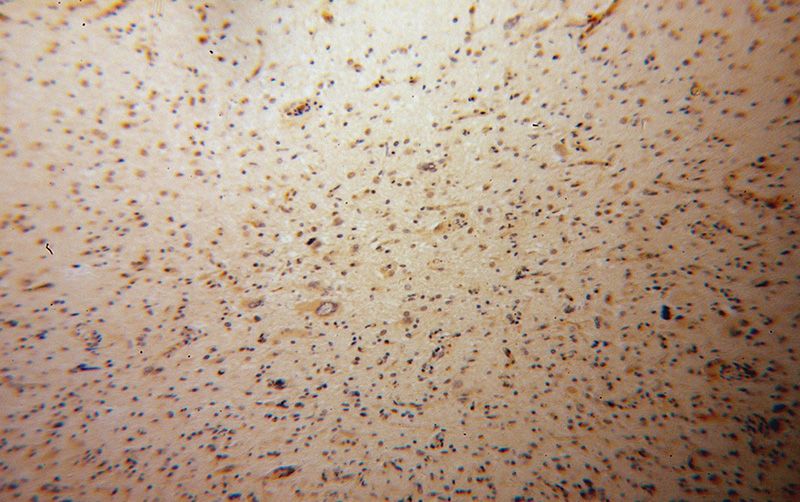 Immunohistochemical of paraffin-embedded human gliomas using Catalog No:108923(CAMKK1 antibody) at dilution of 1:50 (under 10x lens)