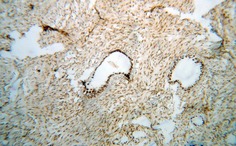 Immunohistochemical of paraffin-embedded human ovary tumor using Catalog No:113578(PAPSS1 antibody) at dilution of 1:100 (under 10x lens)