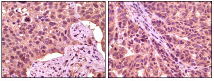 Immunohistochemical analysis of paraffin-embedded human lung carcinoma (left) and skin carcinoma (right), showing cytoplasmic localization using GSK3 aphpa mouse mAb with DAB staining.