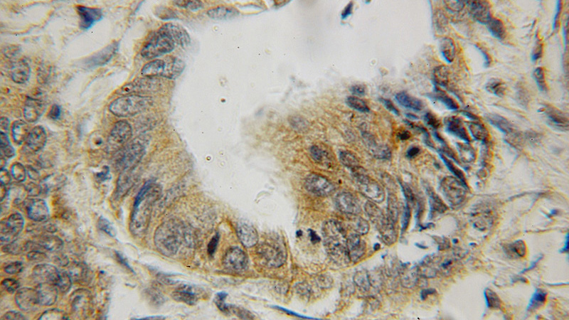 Immunohistochemical of paraffin-embedded human colon cancer using Catalog No:110836(LGALS2 antibody) at dilution of 1:100 (under 10x lens)