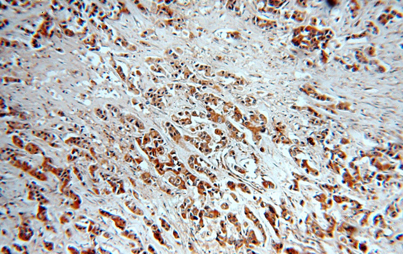 Immunohistochemical of paraffin-embedded human breast cancer using Catalog No:112125(KRT10 antibody) at dilution of 1:50 (under 10x lens)