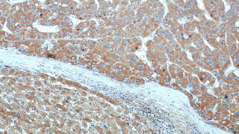 Immunohistochemical of paraffin-embedded human liver cancer using Catalog No:107912(AFP antibody) at dilution of 1:50 (under 10x lens)