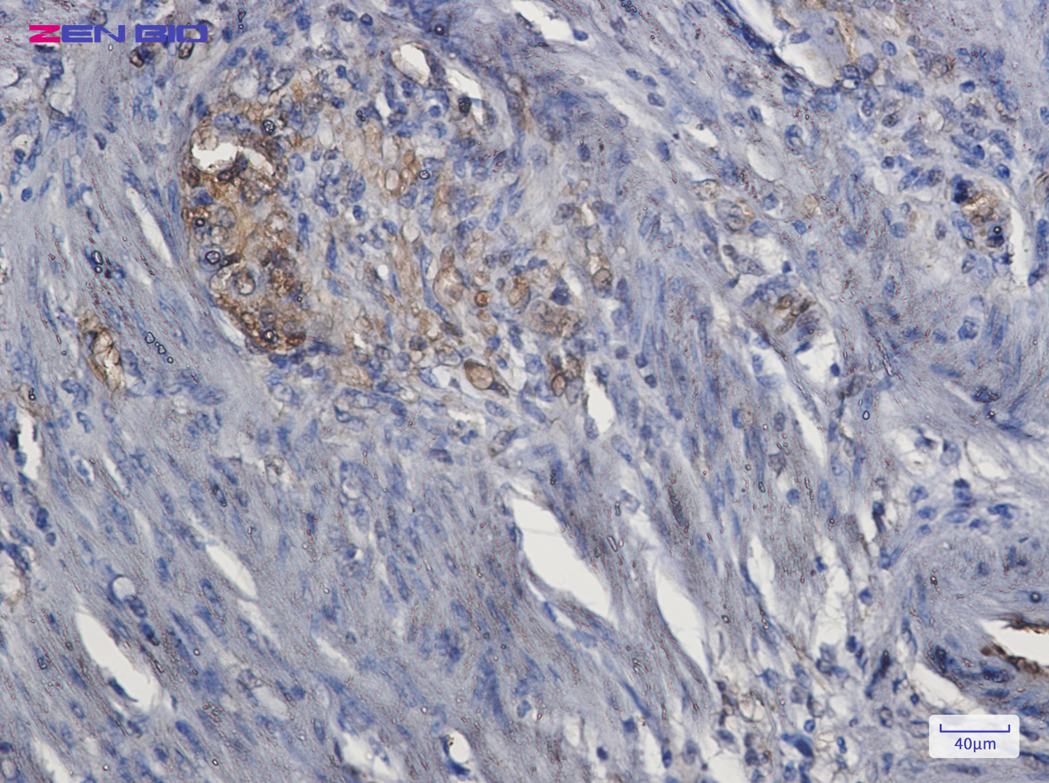 Immunohistochemistry of ERK1 in paraffin-embedded Human colon cancer tissue using ERK1 Rabbit pAb at dilution 1/50