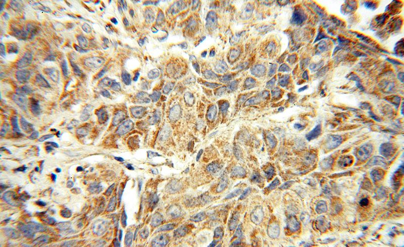 Immunohistochemical of paraffin-embedded human lung cancer using Catalog No:110119(DUSP22 antibody) at dilution of 1:50 (under 40x lens)