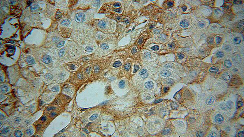Immunohistochemical of paraffin-embedded human liver cancer using Catalog No:108037(APOA1 antibody) at dilution of 1:100 (under 40x lens)