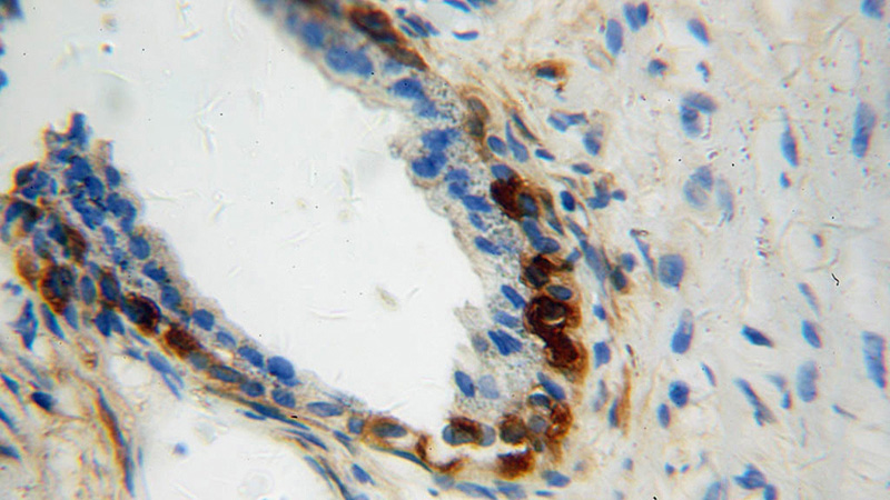 Immunohistochemical of paraffin-embedded human gliomas using Catalog No:112886(CRYM antibody) at dilution of 1:50 (under 40x lens)