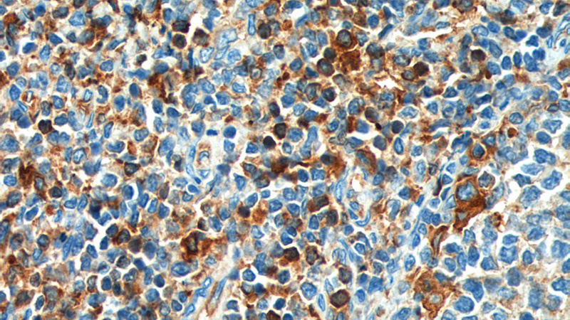 Immunohistochemistry of paraffin-embedded human tonsillitis tissue slide using Catalog No:109129(CD52 Antibody) at dilution of 1:200 (under 40x lens). heat mediated antigen retrieved with Tris-EDTA buffer(pH9).