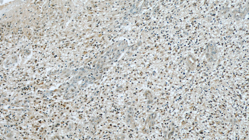 Immunohistochemical of paraffin-embedded human gliomas using Catalog No:110707(FOXO6 antibody) at dilution of 1:50 (under 10x lens)