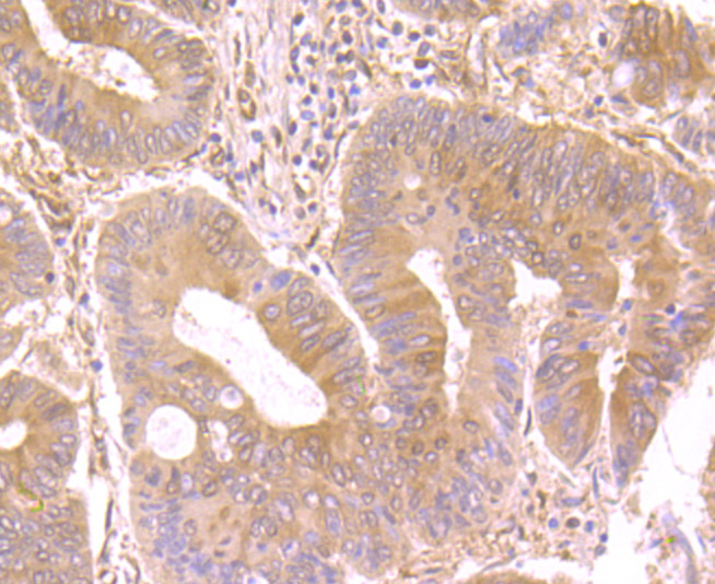Fig7: Immunohistochemical analysis of paraffin-embedded human colon cancer tissue using anti-Nesprin 1 antibody. Counter stained with hematoxylin.