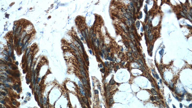 Immunohistochemistry of paraffin-embedded human colon tissue slide using Catalog No:112100(KLHL28 Antibody) at dilution of 1:50 (under 40x lens)