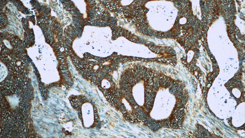 Immunohistochemistry of paraffin-embedded human colon cancer tissue slide using Catalog No:112864(MS4A12 Antibody) at dilution of 1:50