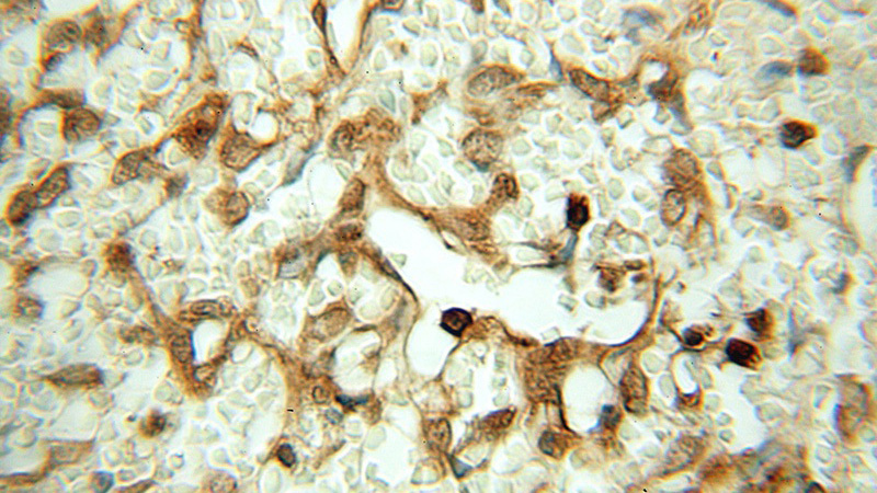 Immunohistochemical of paraffin-embedded human ovary tumor using Catalog No:107974(ALDH7A1 antibody) at dilution of 1:50 (under 40x lens)