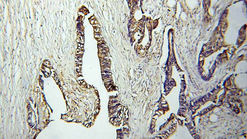Immunohistochemical of paraffin-embedded human breast cancer using Catalog No:112706(MMP3 antibody) at dilution of 1:100 (under 10x lens)